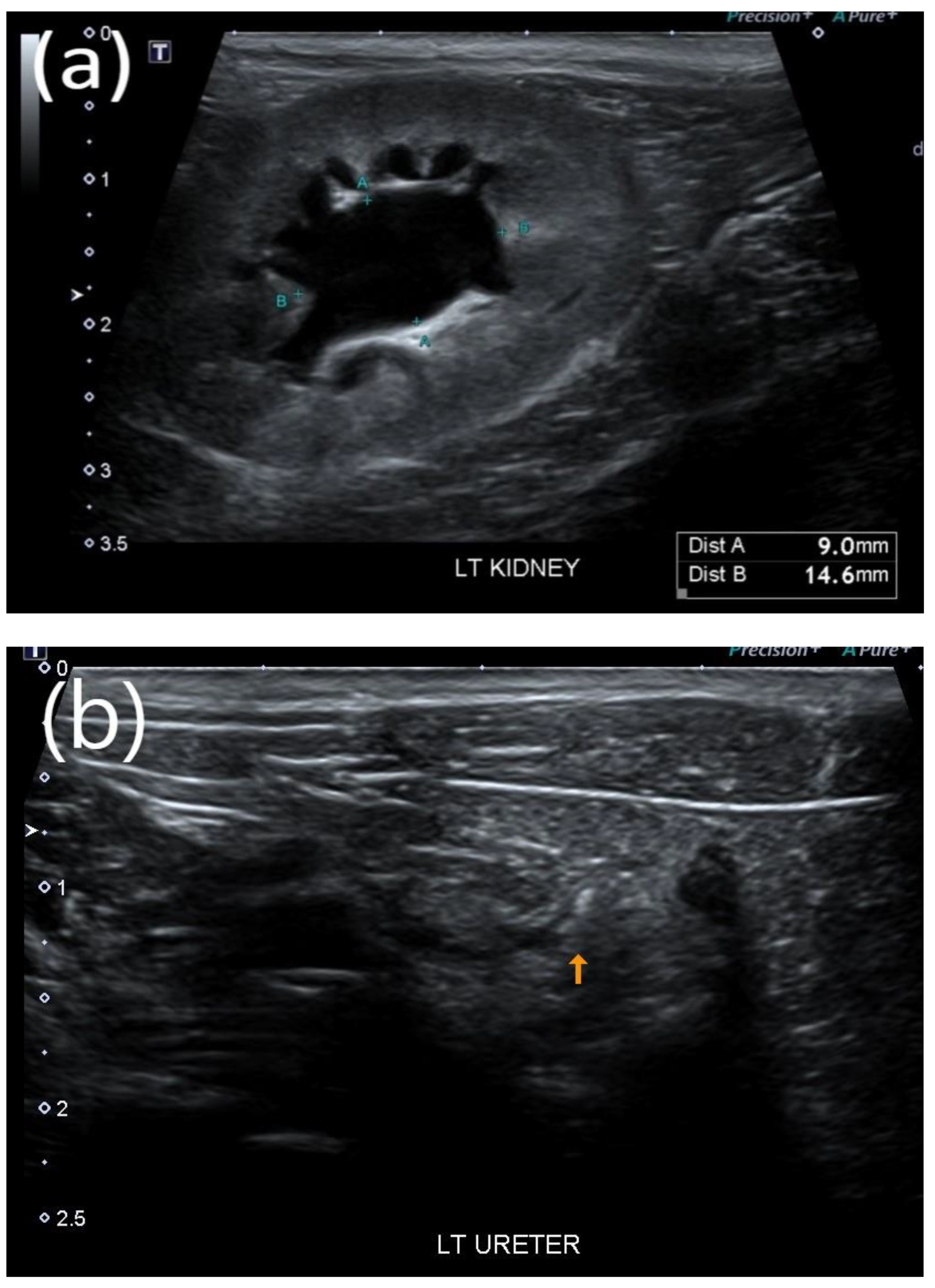 kidney stones ultrasound