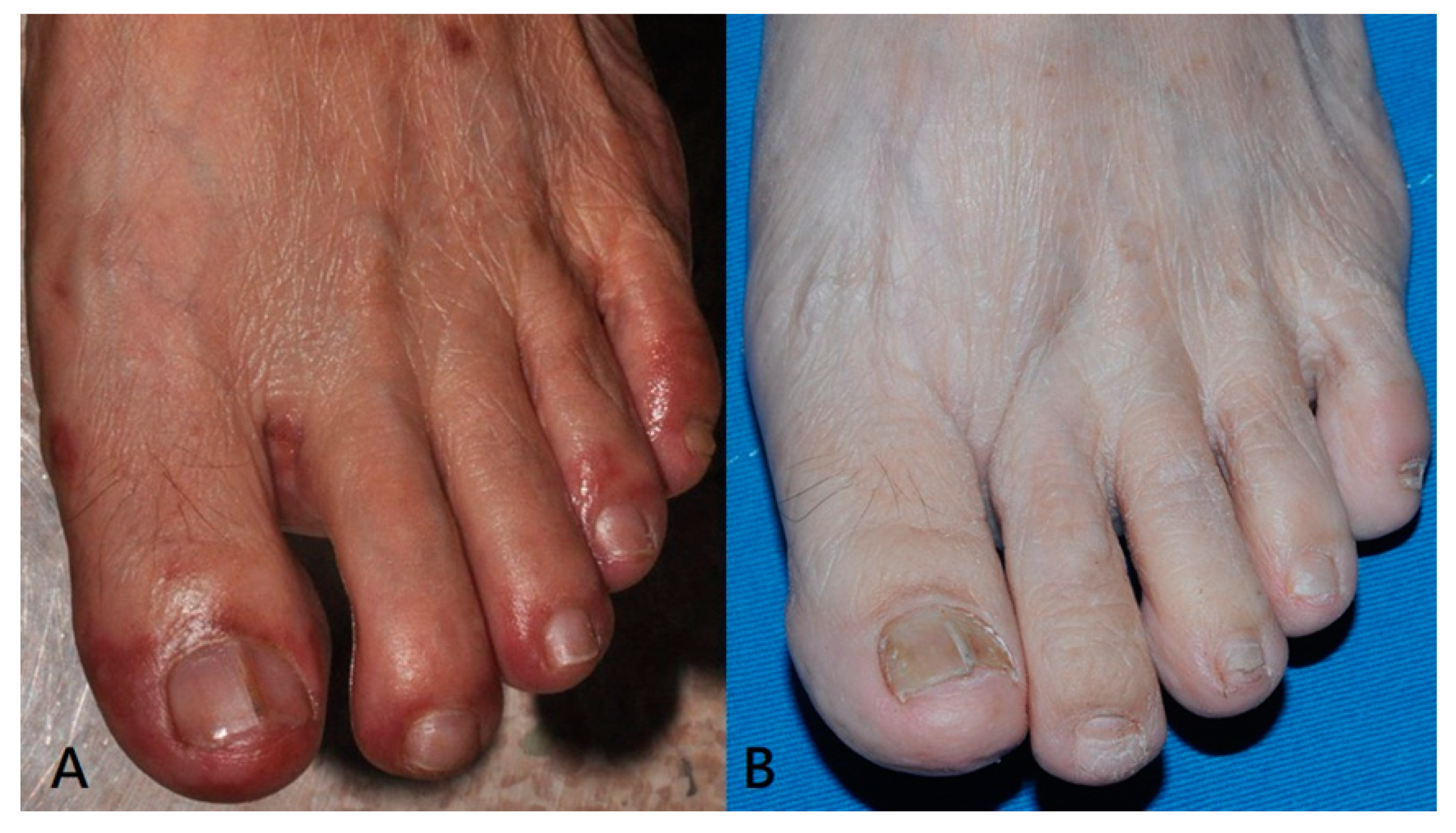 PDF) Nail Change after Chemotherapy: Simultaneous Development of Beau's  Lines and Mees' Lines