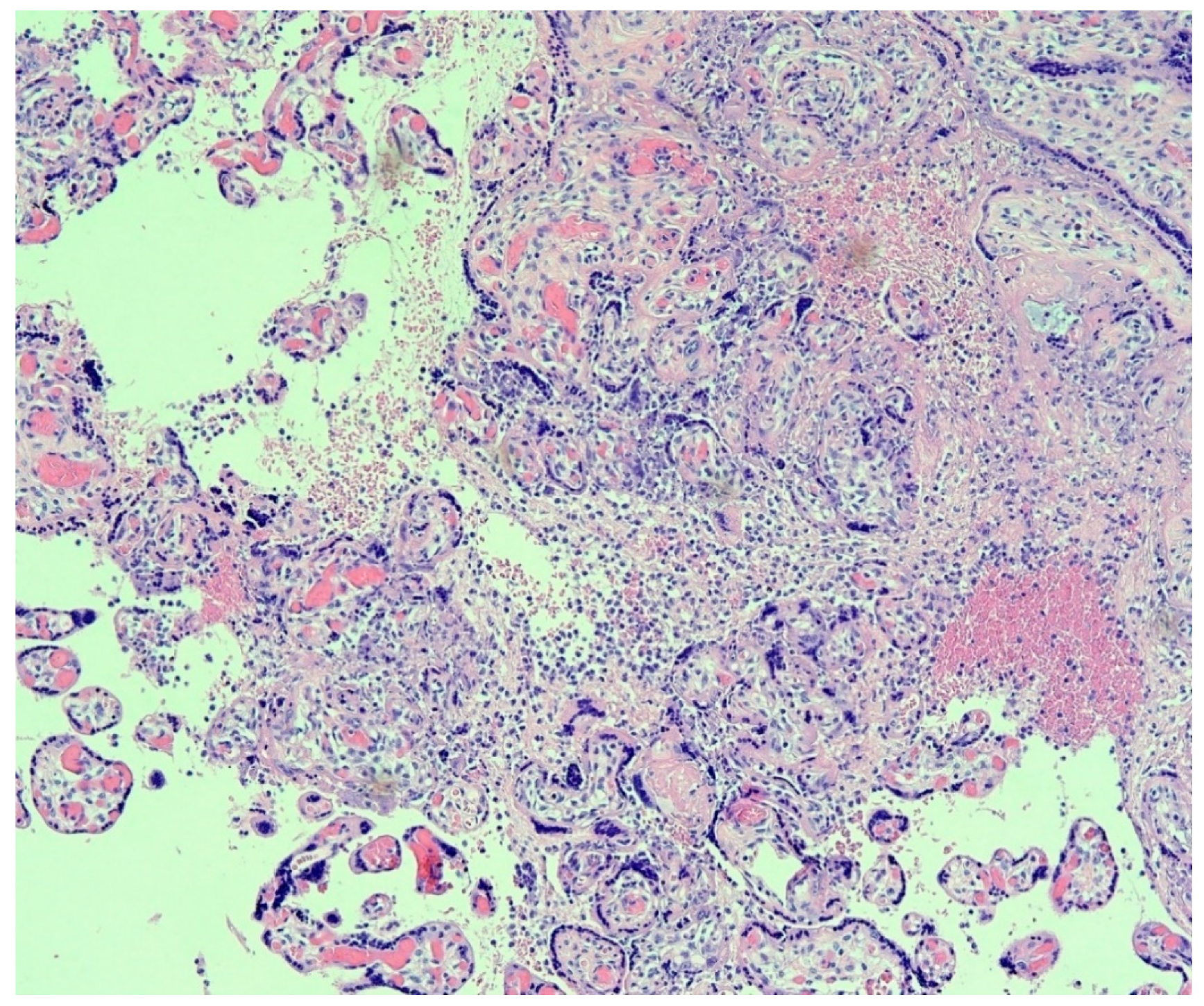 Viruses | Free Full-Text | Placental Pathology of COVID-19 with and without  Fetal and Neonatal Infection: Trophoblast Necrosis and Chronic Histiocytic  Intervillositis as Risk Factors for Transplacental Transmission of  SARS-CoV-2
