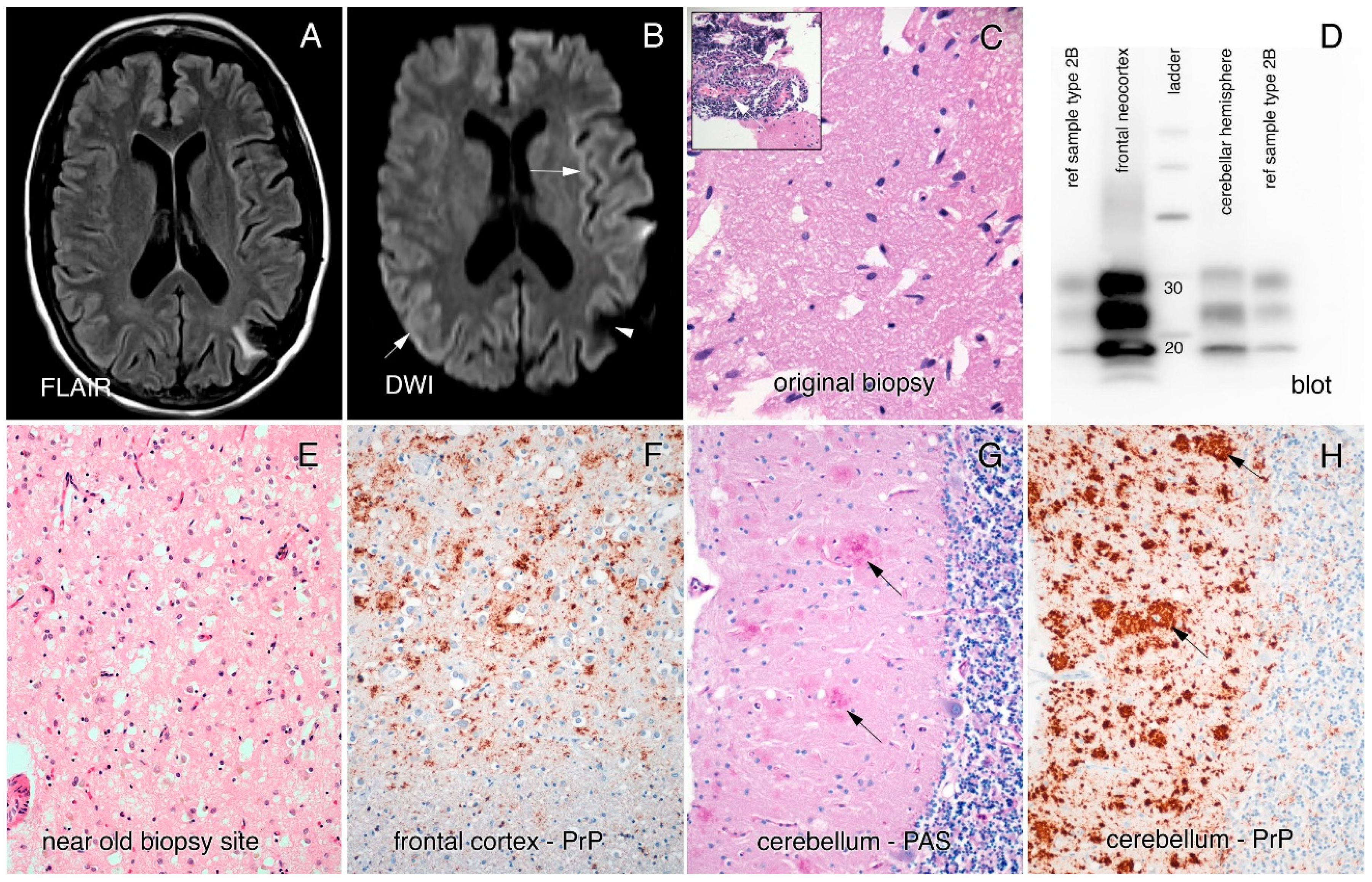 Viruses | Free Full-Text | Creutzfeldt–Jakob Disease with a Five-Year  Clinical Course, Multicentric Cerebellar Prion Plaques and Prior History of  Biopsy-Proven Primary Angiitis of the Central Nervous System: A Case for  Iatrogenic