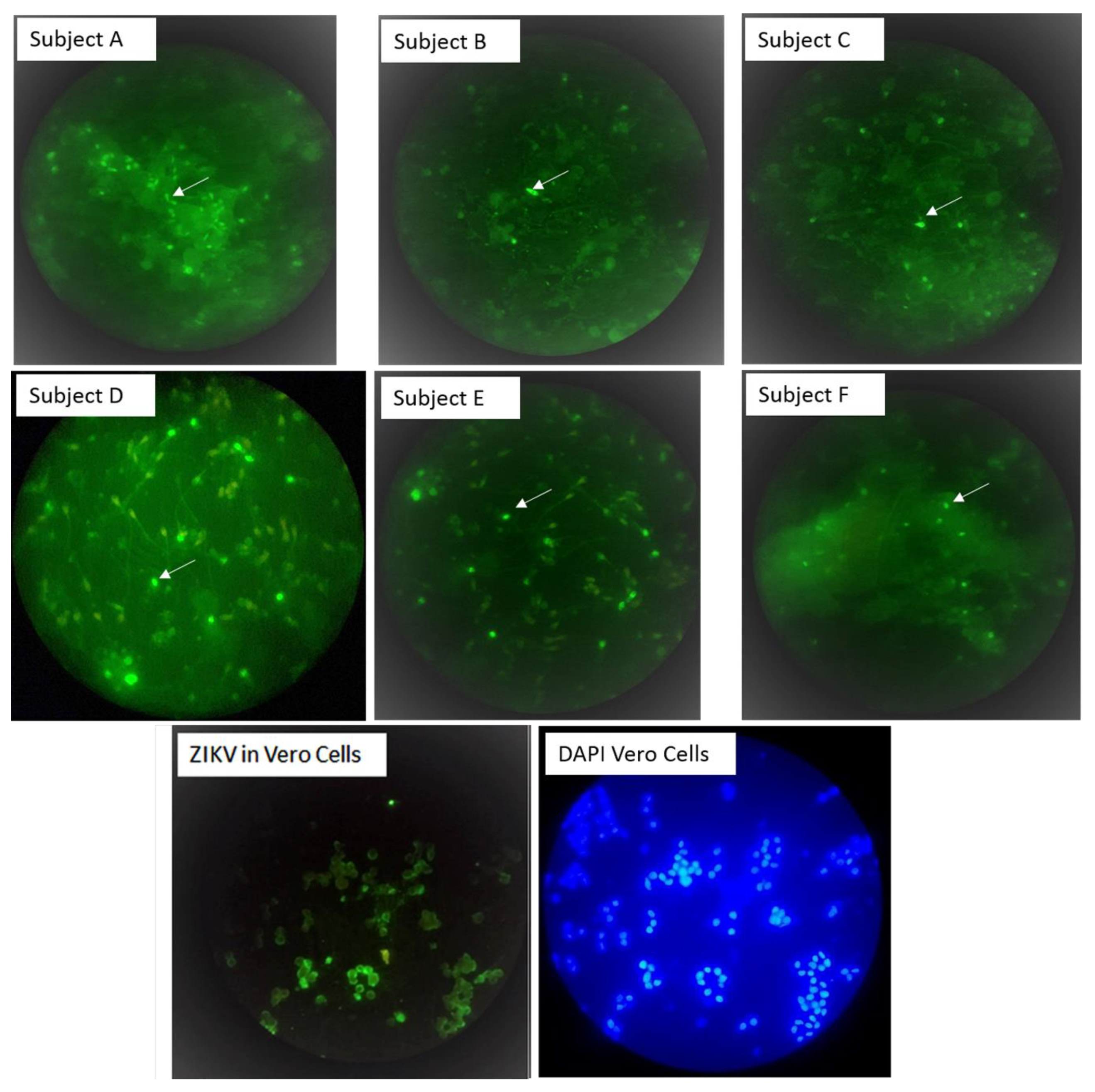 Viruses | Free Full-Text | Zika RNA and Flavivirus-Like Antigens in the  Sperm Cells of Symptomatic and Asymptomatic Subjects